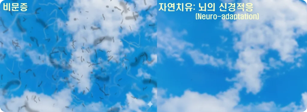 비문증 자연치유될까? 불안감을 확 낮춰주는 뇌의 놀라운 적응법